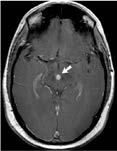 CT Scan Brain Tumor