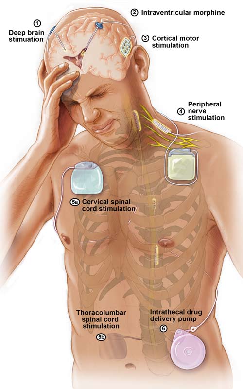 Spine Center Pain Management, Georgia Regents Neuroscience Center