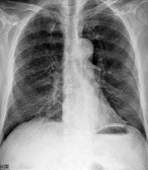 Epidural Electrode Wire, Spinal Stimulator Treatment, Georgia Regents Neuroscience Center